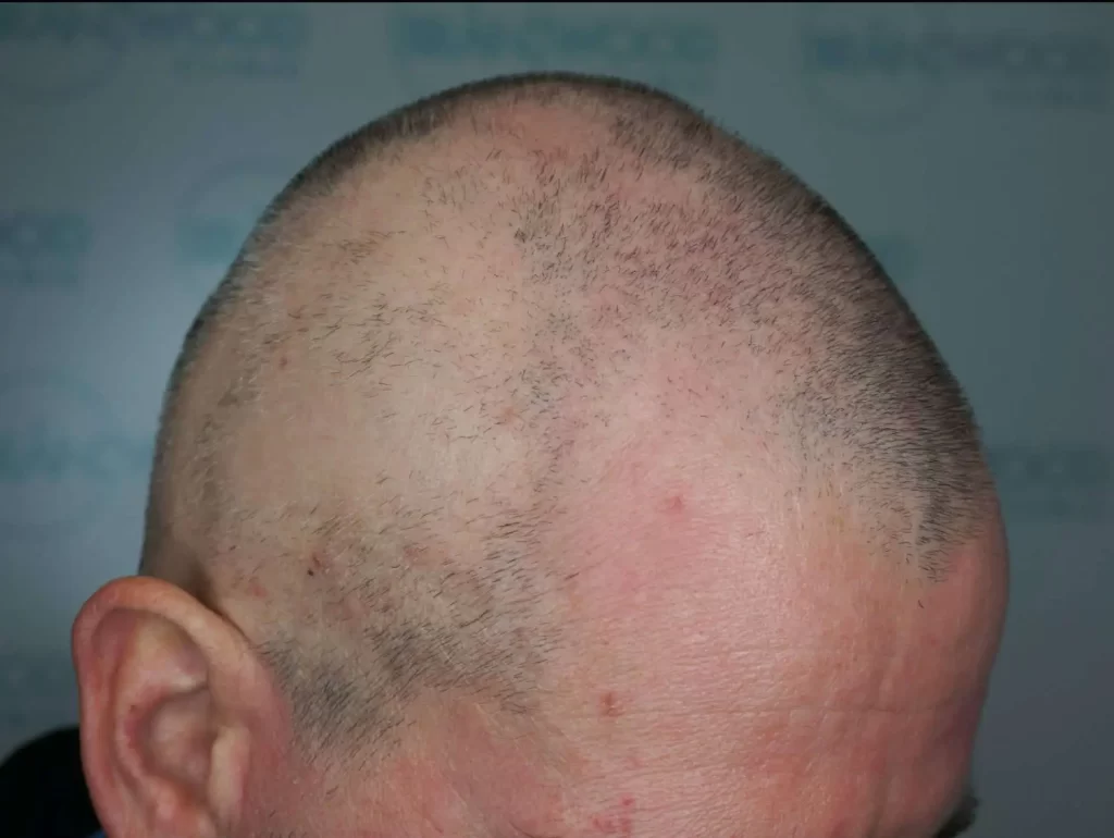 Alopecia Antes de la Micropigmentación